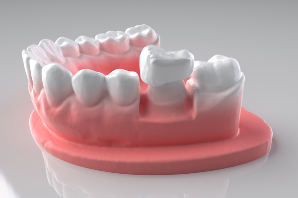 What To Do If Your Dental Crown Falls Off