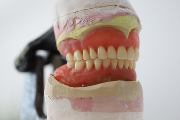 Overdentures Supported By Dental Implants