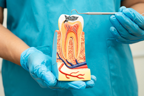 Common Reasons For Root Canal Therapy
